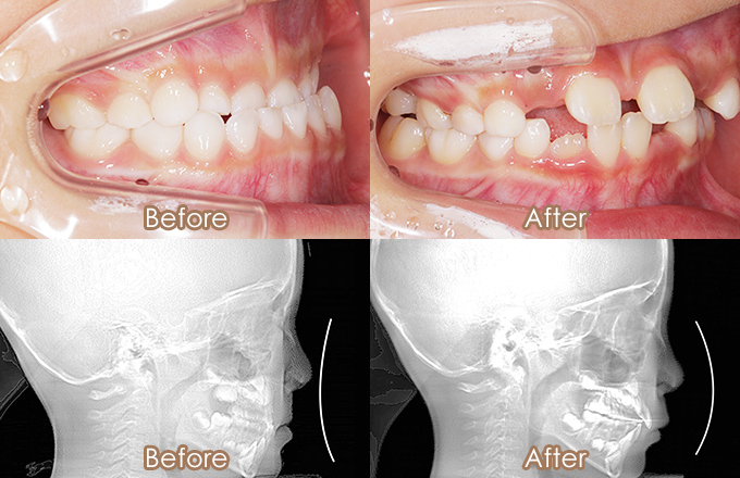 小児矯正治療前と1年3ヶ月後の比較画像（側面口腔内写真とセファロレントゲンの経過）
