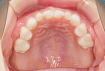 矯正歯科治療前の上顎咬合面写真（歯列不正の状態）