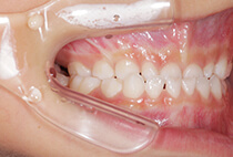 矯正歯科治療前の左側面口腔内写真（噛み合わせの状態）