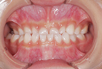 矯正歯科治療前の正面口腔内写真（前歯の歯並び）