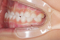 矯正歯科治療前の右側面口腔内写真（咬合の様子）