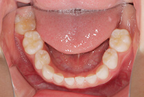 矯正歯科治療前の下顎咬合面写真（歯列の状態）