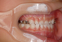 5歳7ヶ月小児矯正治療開始時の側面口腔内写真