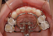 5歳7ヶ月小児矯正治療開始時の上顎咬合面写真