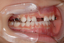 小児矯正1ヶ月経過・5歳8ヶ月の側面口腔内写真