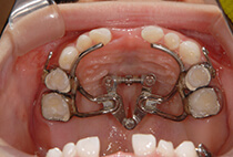 小児矯正1ヶ月経過・5歳8ヶ月の上顎咬合面写真