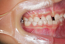 小児矯正開始7ヶ月後・6歳2ヶ月時点の側面口腔内写真