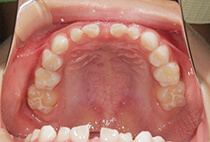 小児矯正7ヶ月経過・6歳2ヶ月の上顎咬合面写真