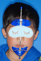 小児矯正・6歳症例治療前正面写真