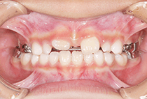 7歳1ヶ月・2回目の拡大装置使用中の正面口腔内写真