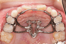 7歳1ヶ月・2回目の拡大装置による上顎拡大治療中の咬合面写真