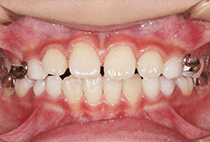 8歳1ヶ月・3回目の拡大装置による正面口腔内写真