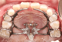 8歳1ヶ月・3回目の拡大装置による上顎拡大の咬合面写真