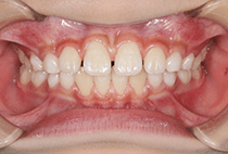 8歳8ヶ月・夜間マウスピースへ移行後の正面口腔内写真