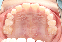 8歳8ヶ月・夜間マウスピース矯正中の上顎咬合面写真