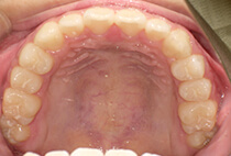 小児矯正マウスピース卒業時の上顎咬合面写真