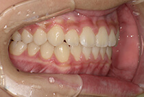 小児矯正マウスピース卒業時の左側面口腔内写真