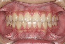 小児矯正マウスピース卒業時の正面口腔内写真