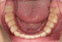 小児矯正マウスピース卒業時の下顎咬合面写真