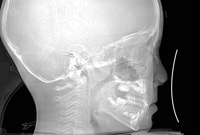 小児矯正治療前の側面セファロレントゲン画像（骨格と噛み合わせの状態）