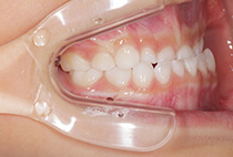 小児矯正治療前の側面口腔内写真（歯並びと咬合の状態）