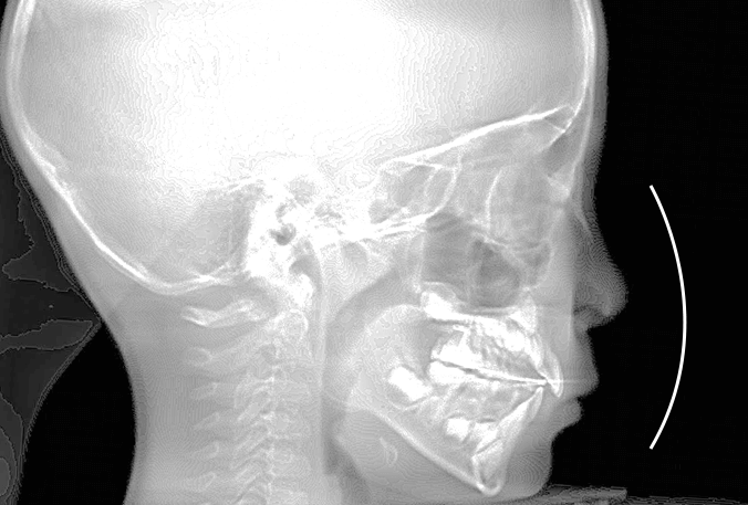 小児矯正開始から1年3ヶ月後の側面セファロレントゲン画像（骨格改善の経過）