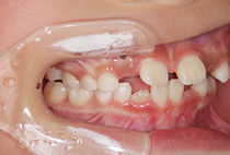 小児矯正1年3ヶ月経過時の側面口腔内写真（噛み合わせの変化）